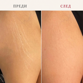Комплект Силиконовите Пачове за Тяло