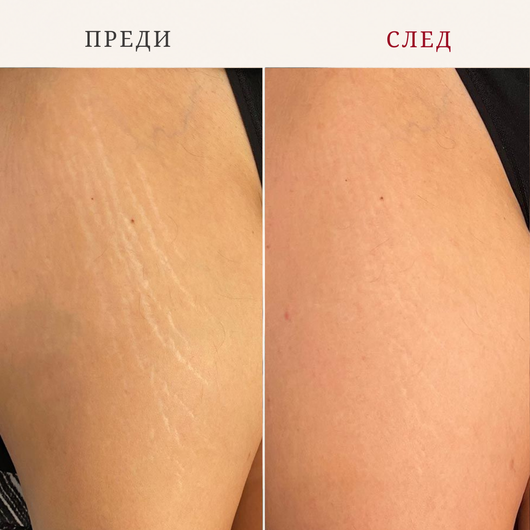 Комплект Силиконови Пачове за Тяло